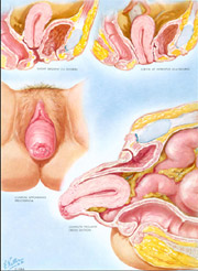 PATHOLOGIE PROLAPSUS GENITAL, DESCENTE D'ORGANE